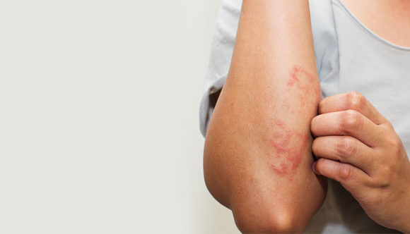 7 Lifestyle Tips to Manage Psoriasis