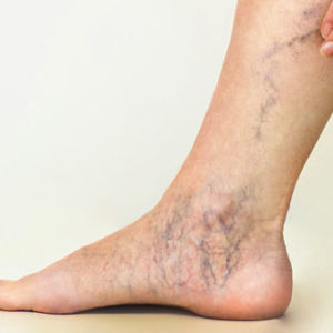 Varicose Vein