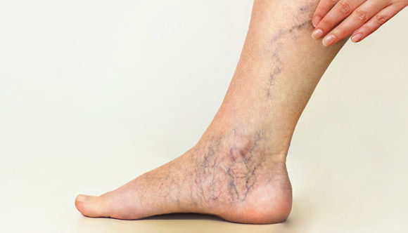 Varicose Vein