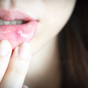 A Diet to Soothe Mouth Ulcers