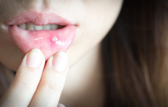 A Diet to Soothe Mouth Ulcers